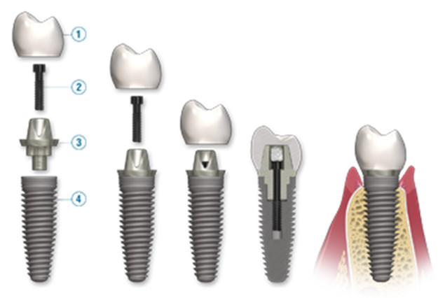 Partes que componen un implante dental
