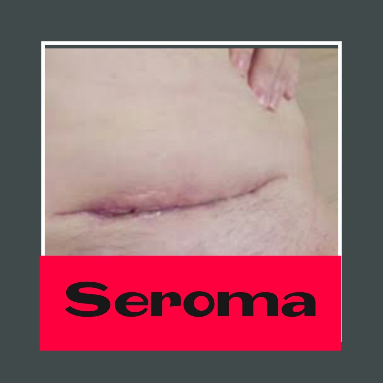 Como curar un seroma de cesarea en casa
